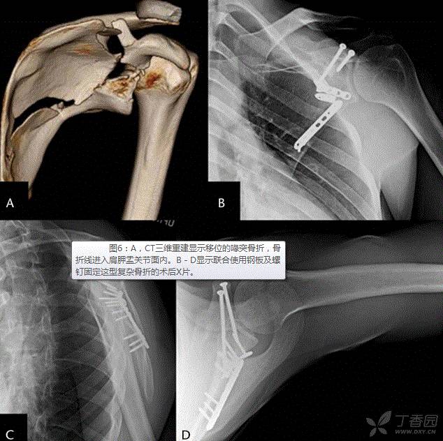 一文读懂：喙突骨折的手术技巧及经验