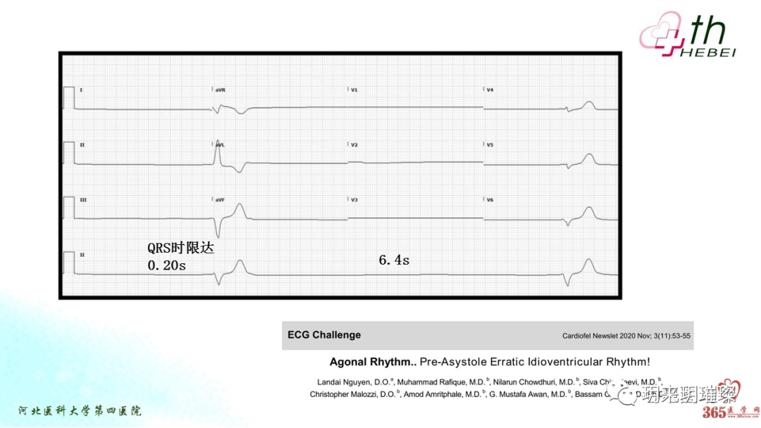 心电图如何报告死亡与濒死心电图​诊断