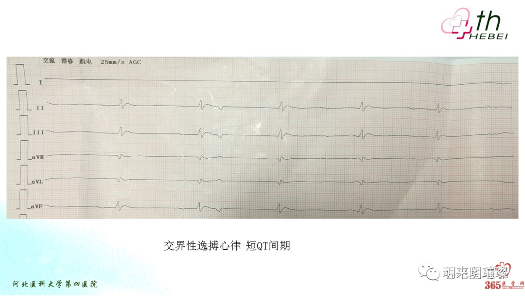 心电图如何报告死亡与濒死心电图​诊断