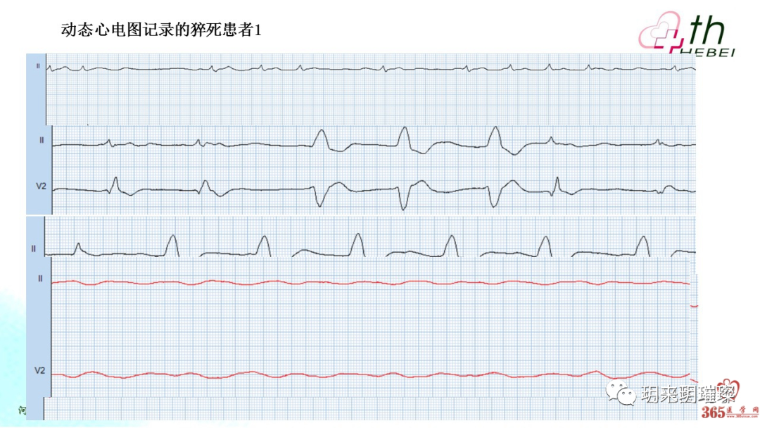 心电图如何报告死亡与濒死心电图​诊断