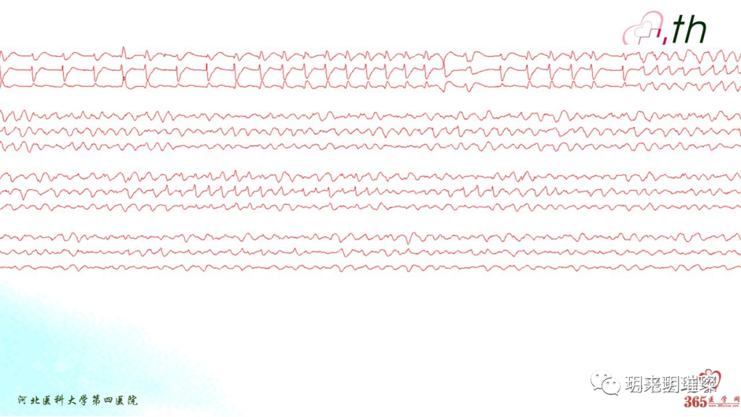 心电图如何报告死亡与濒死心电图​诊断