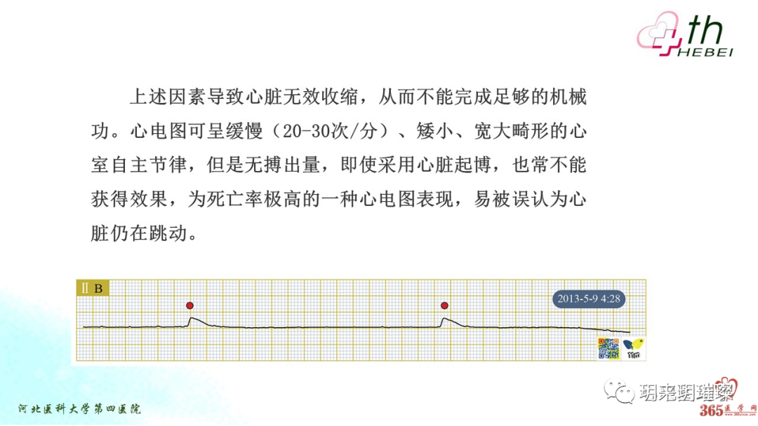 心电图如何报告死亡与濒死心电图​诊断