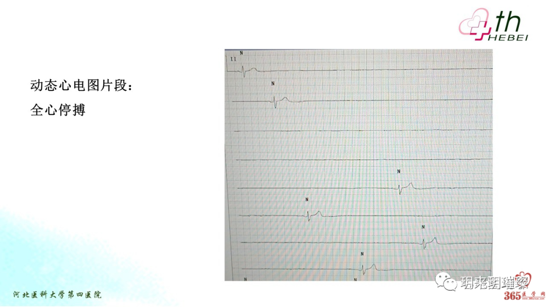 心电图如何报告死亡与濒死心电图​诊断