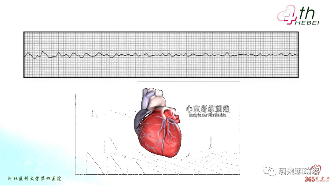 心电图如何报告死亡与濒死心电图​诊断