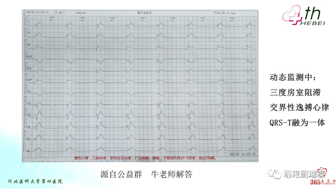 心电图如何报告死亡与濒死心电图​诊断