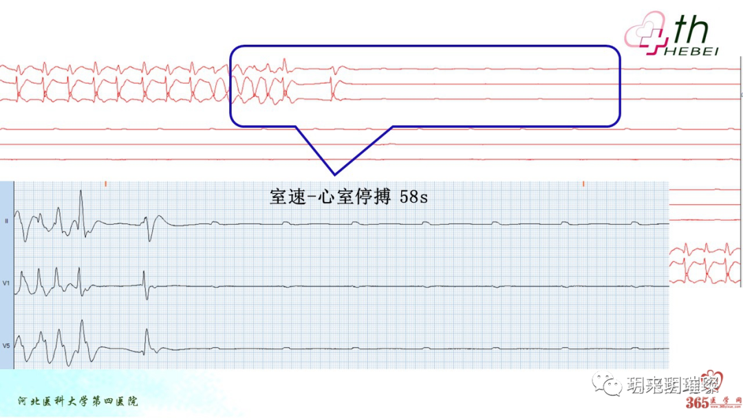 心电图如何报告死亡与濒死心电图​诊断