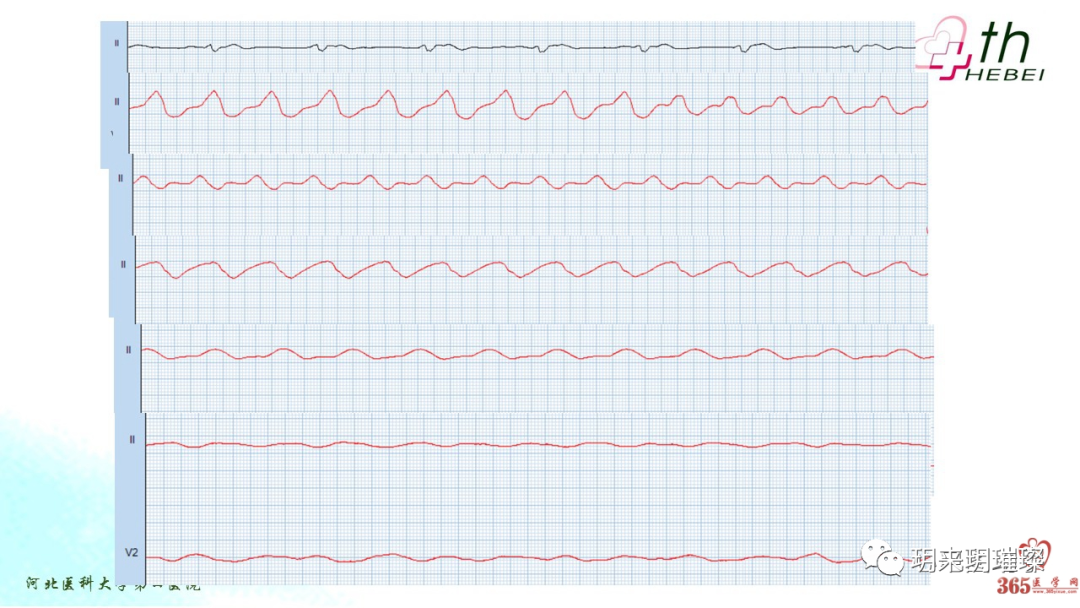 心电图如何报告死亡与濒死心电图​诊断