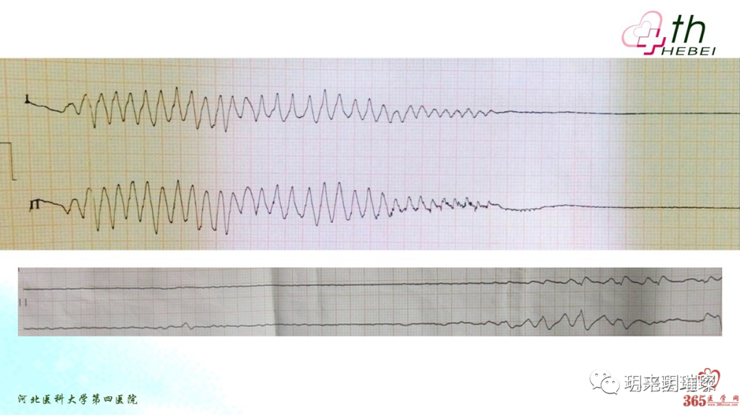 心电图如何报告死亡与濒死心电图​诊断
