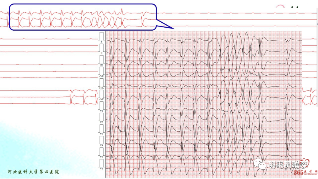 心电图如何报告死亡与濒死心电图​诊断