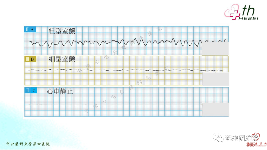 心电图如何报告死亡与濒死心电图​诊断