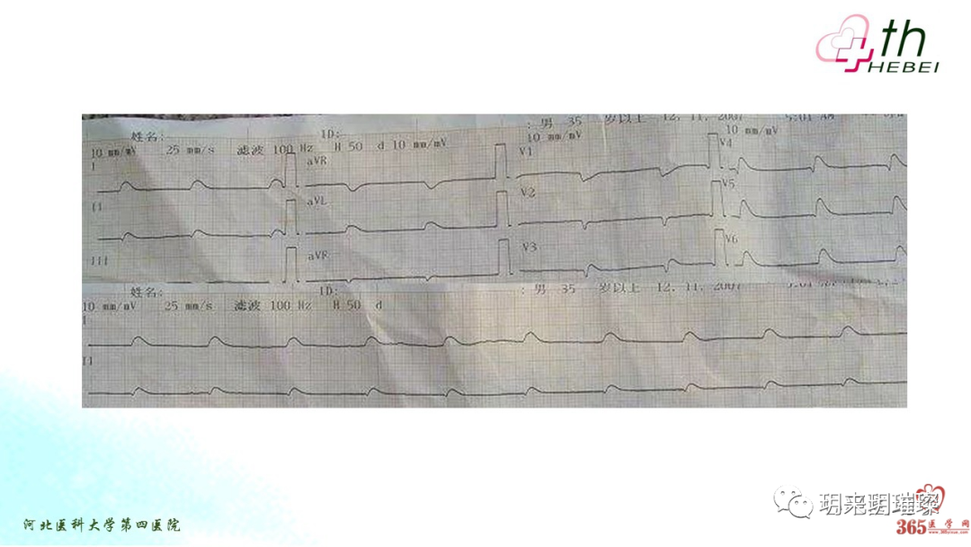 心电图如何报告死亡与濒死心电图​诊断