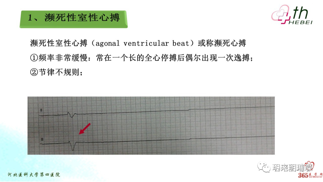 心电图如何报告死亡与濒死心电图​诊断
