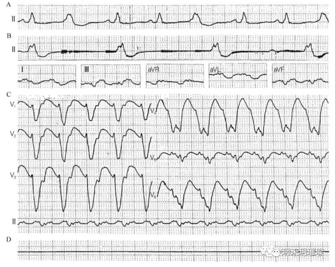 心电图如何报告死亡与濒死心电图​诊断