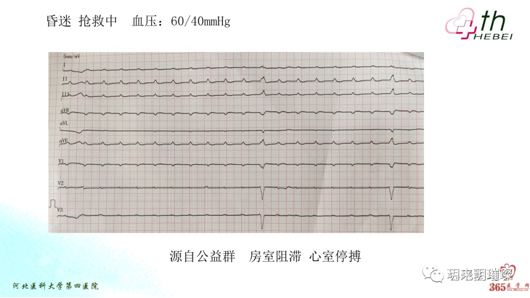 心电图如何报告死亡与濒死心电图​诊断