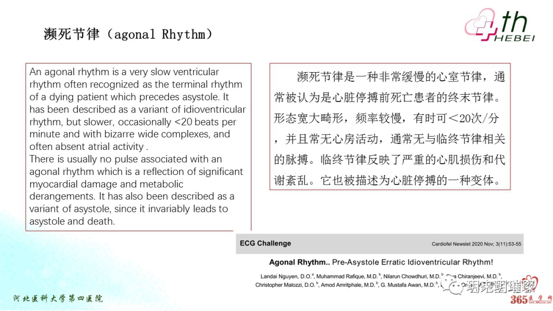 心电图如何报告死亡与濒死心电图​诊断