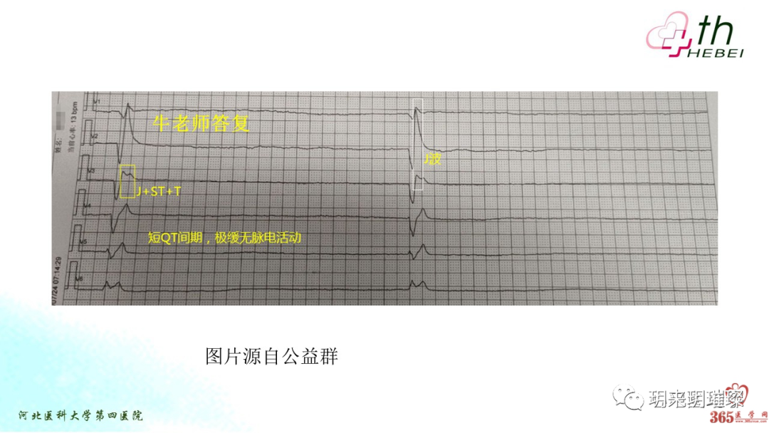 心电图如何报告死亡与濒死心电图​诊断