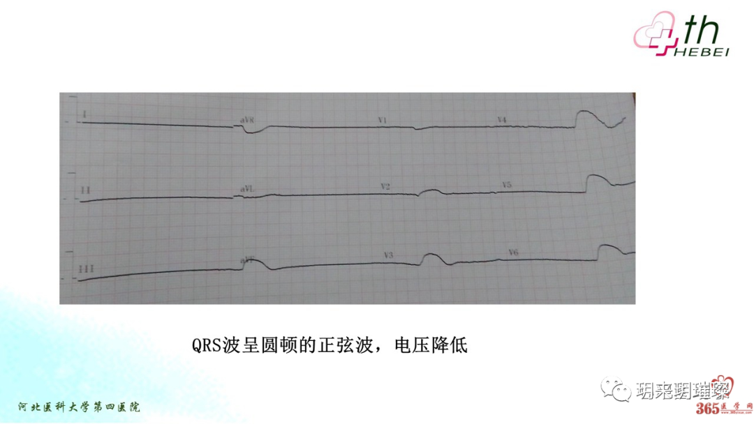心电图如何报告死亡与濒死心电图​诊断