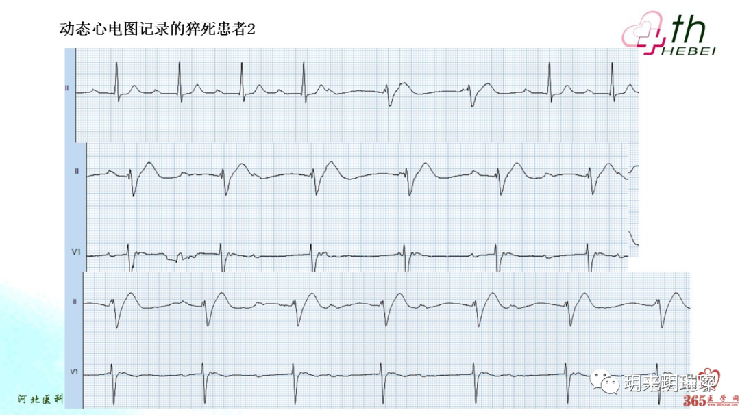 心电图如何报告死亡与濒死心电图​诊断