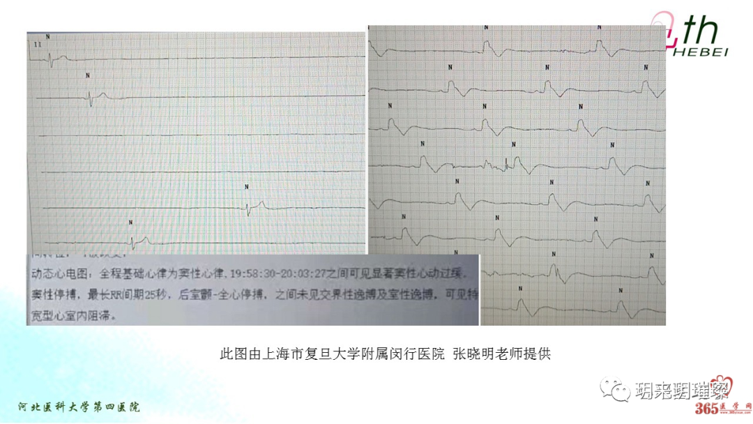 心电图如何报告死亡与濒死心电图​诊断