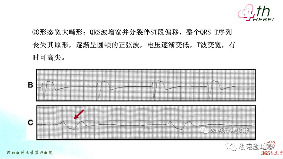 心电图如何报告死亡与濒死心电图​诊断