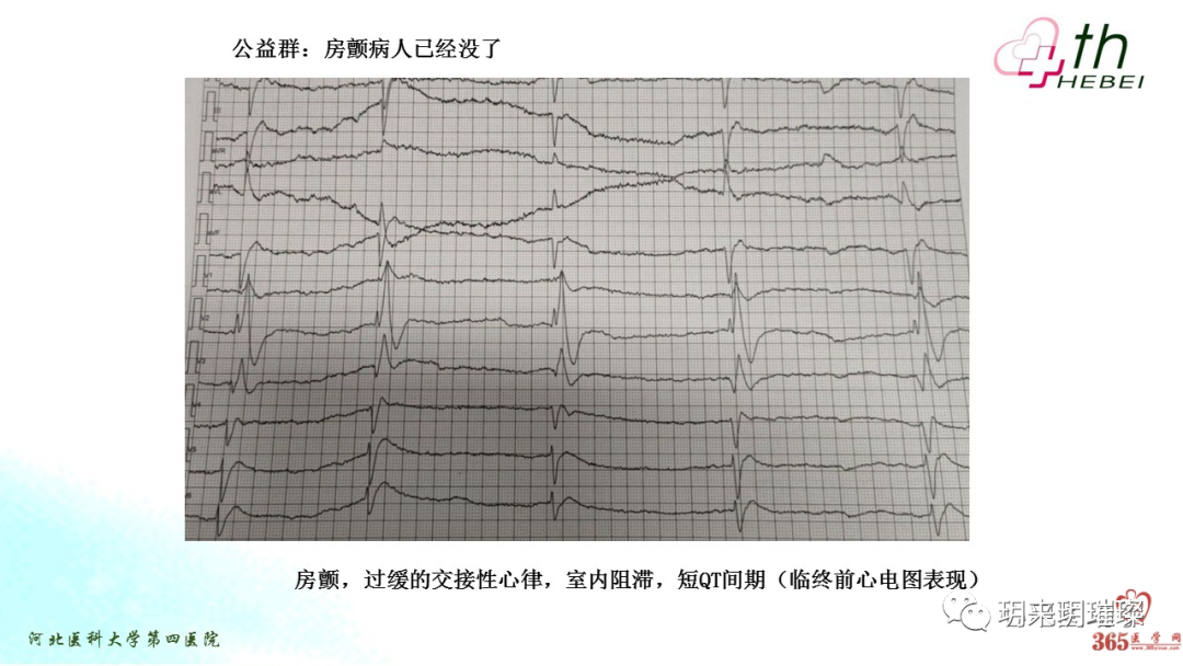 心电图如何报告死亡与濒死心电图​诊断