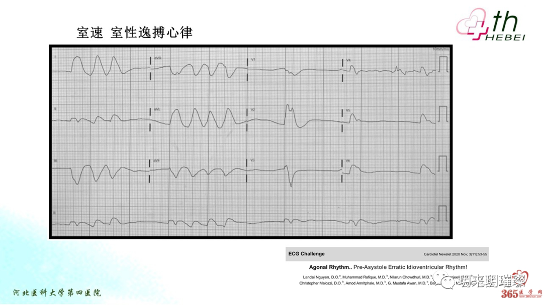 心电图如何报告死亡与濒死心电图​诊断
