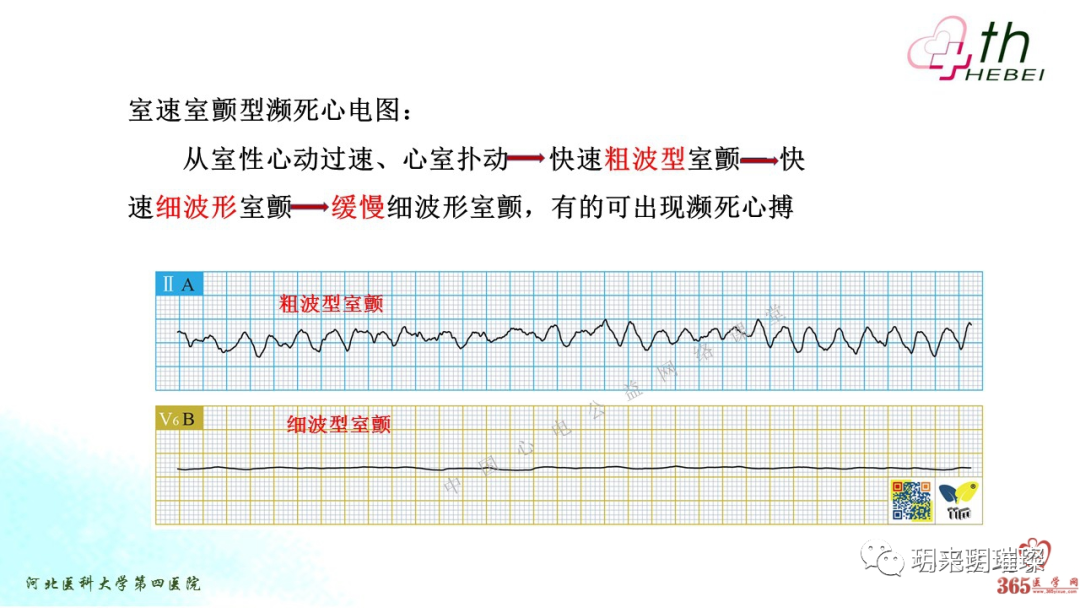 心电图如何报告死亡与濒死心电图​诊断