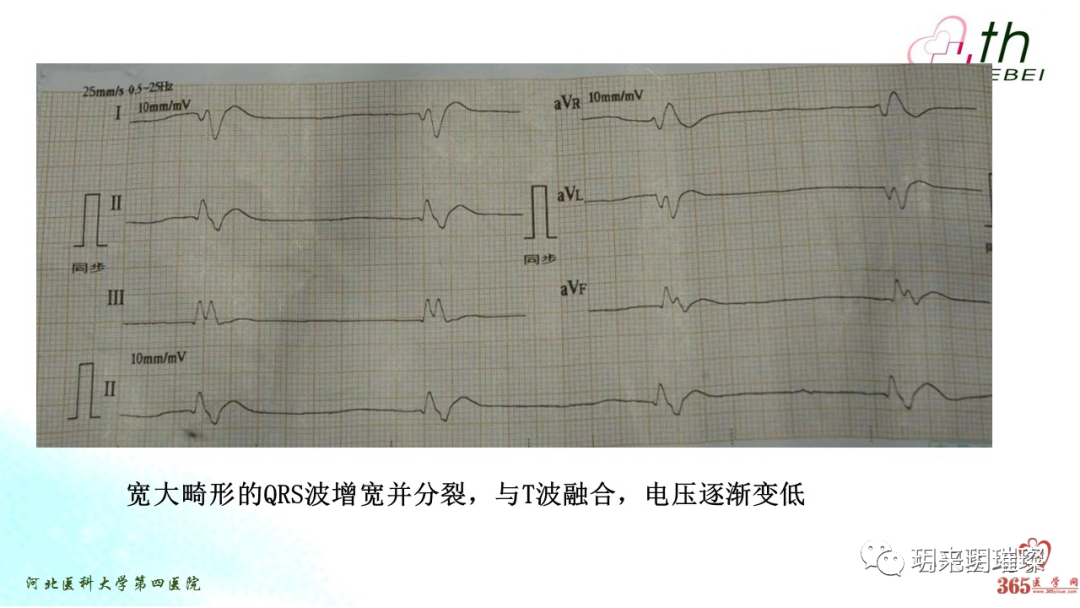 心电图如何报告死亡与濒死心电图​诊断