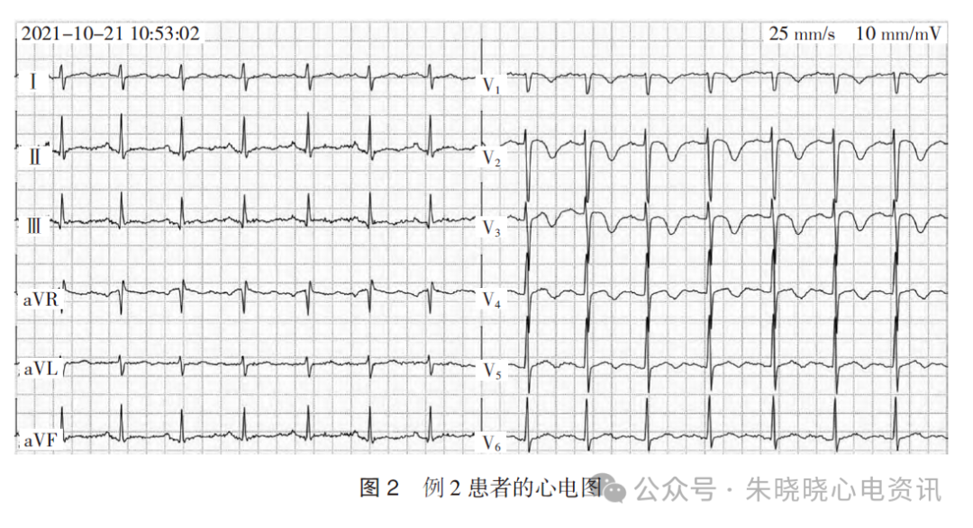 不常见的成人右胸V1~V3