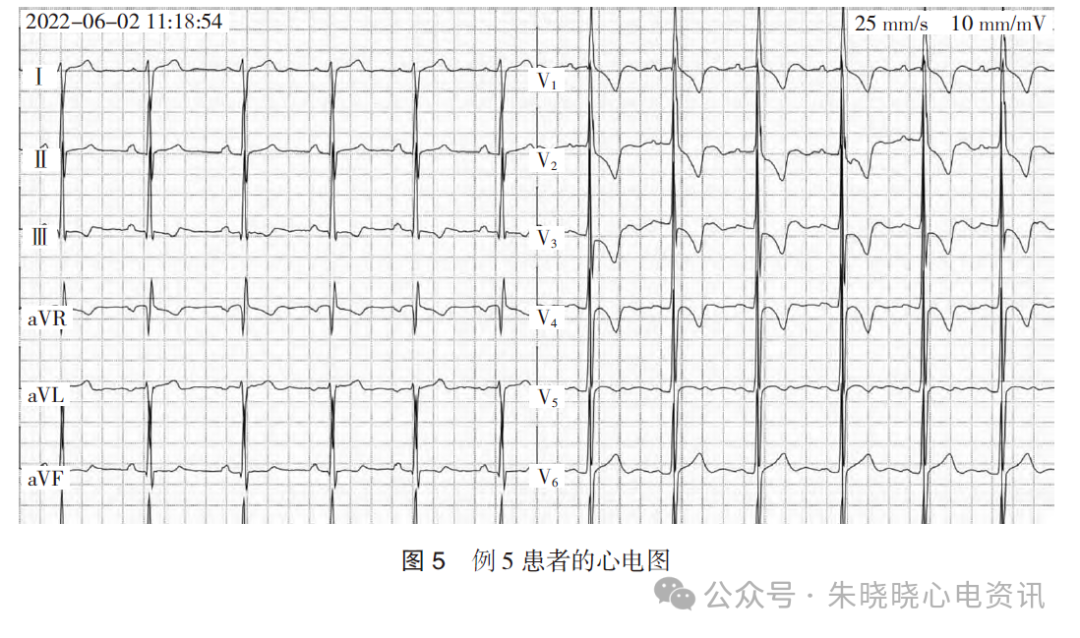 不常见的成人右胸V1~V3