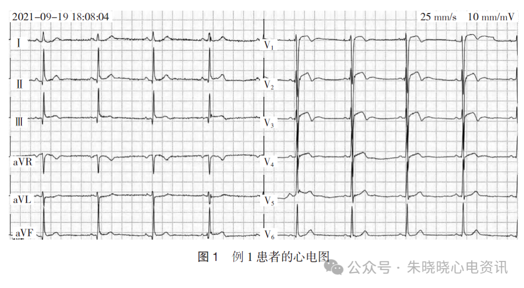不常见的成人右胸V1~V3