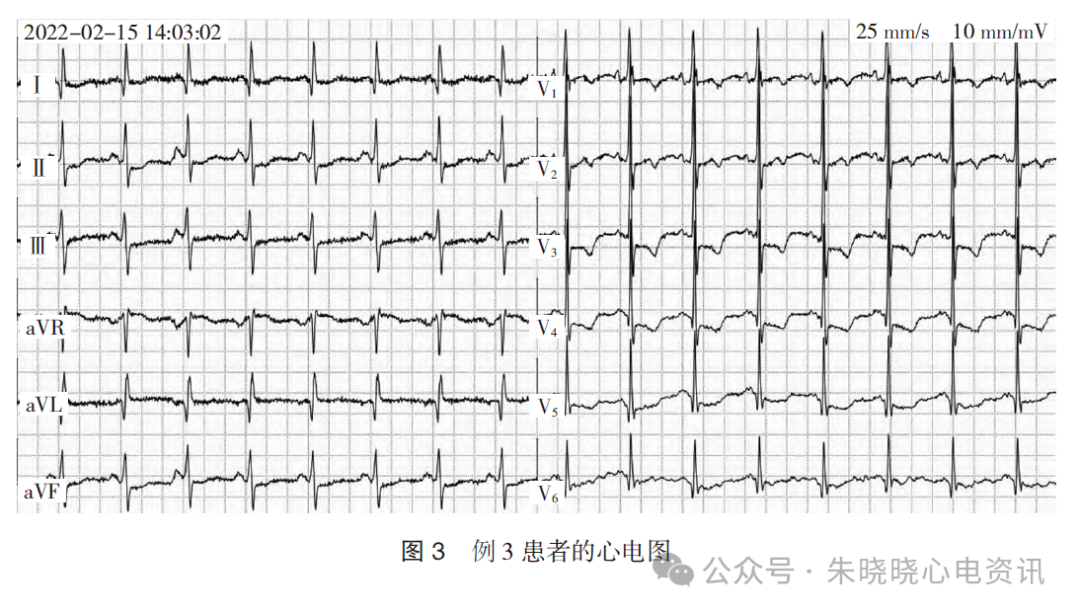不常见的成人右胸V1~V3
