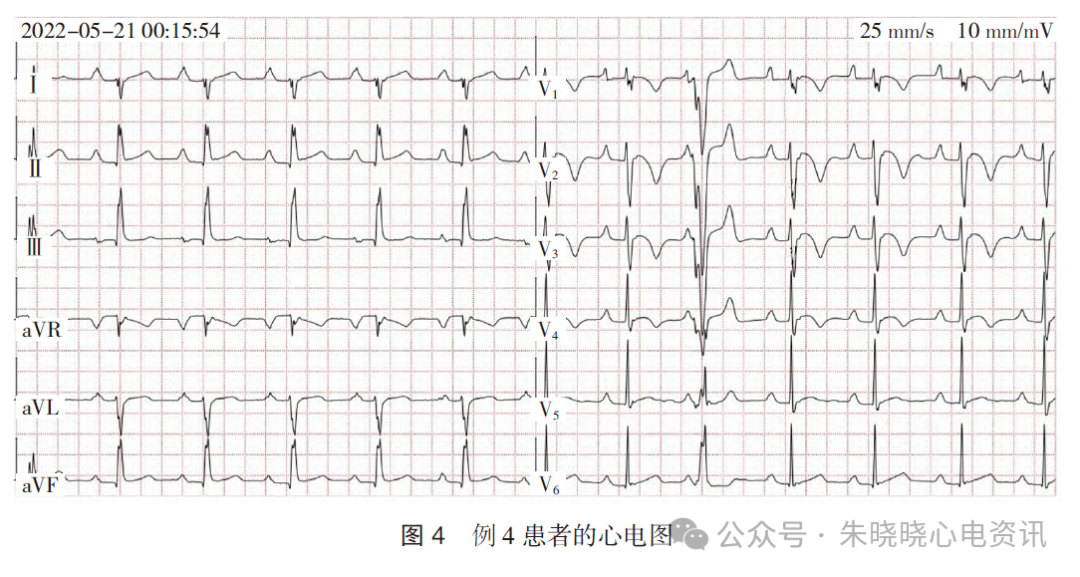 不常见的成人右胸V1~V3