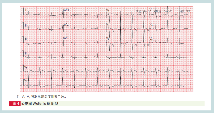 心肌梗死心电图诊断标准和报告规范中国专家共识发布