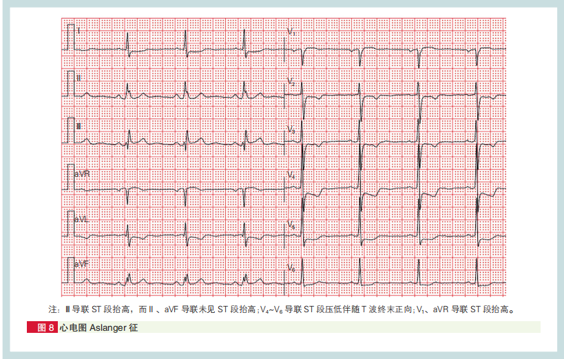 心肌梗死心电图诊断标准和报告规范中国专家共识发布