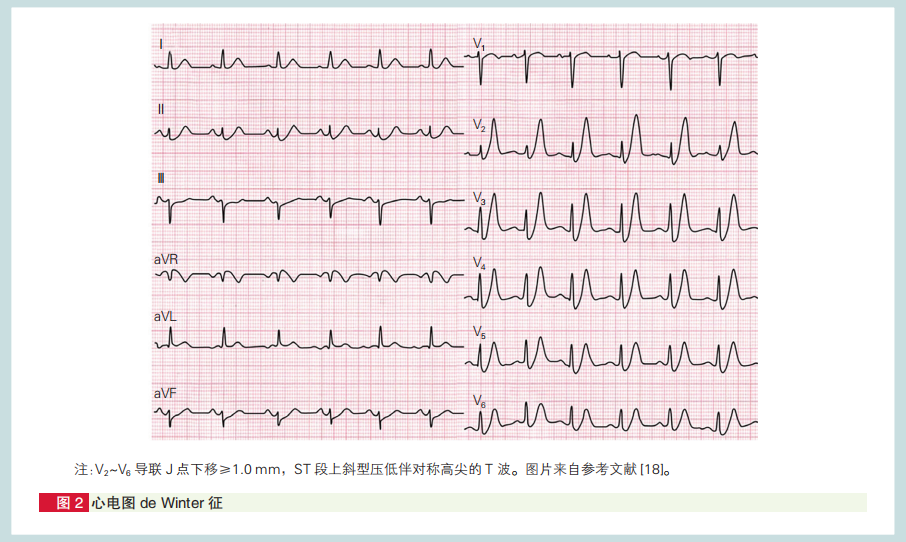 心肌梗死心电图诊断标准和报告规范中国专家共识发布