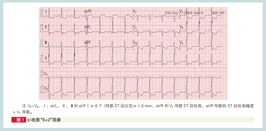 心肌梗死心电图诊断标准和报告规范中国专家共识发布