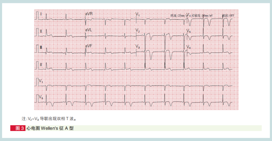 心肌梗死心电图诊断标准和报告规范中国专家共识发布