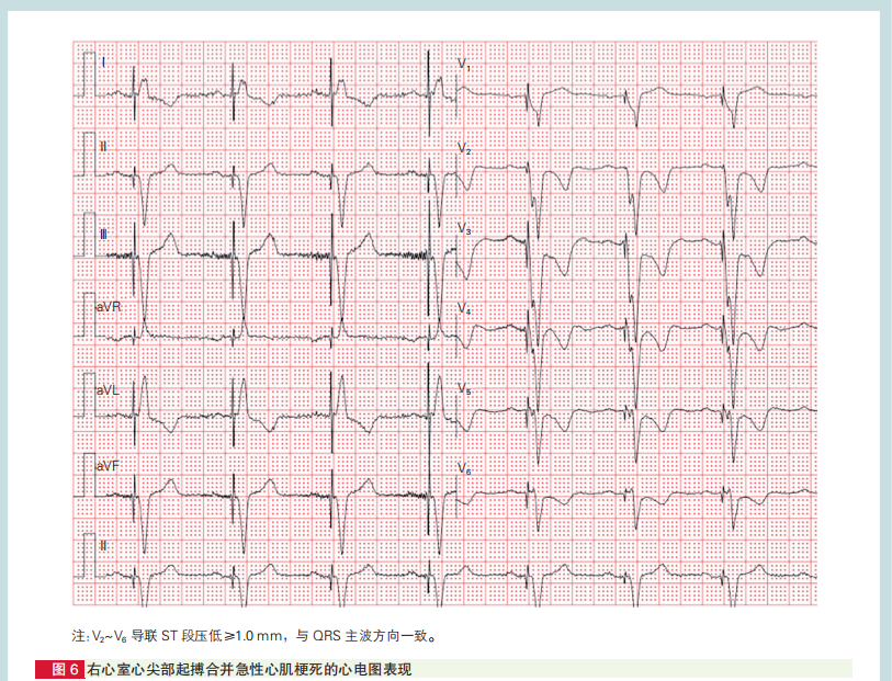 心肌梗死心电图诊断标准和报告规范中国专家共识发布