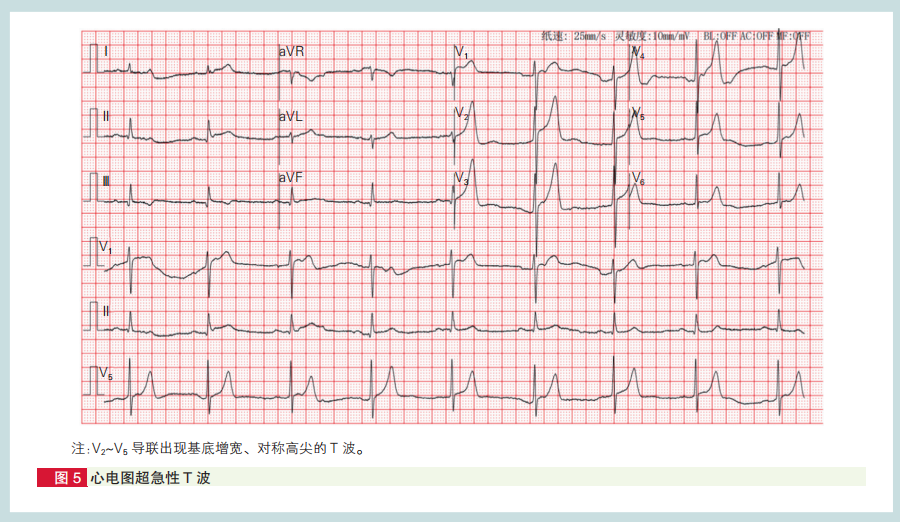 心肌梗死心电图诊断标准和报告规范中国专家共识发布