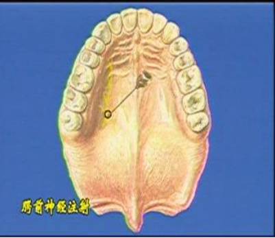 麻醉术:口腔局部麻醉