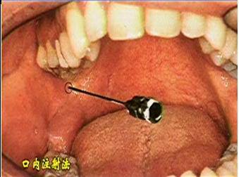 麻醉术:口腔局部麻醉