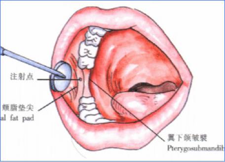 麻醉术:口腔局部麻醉