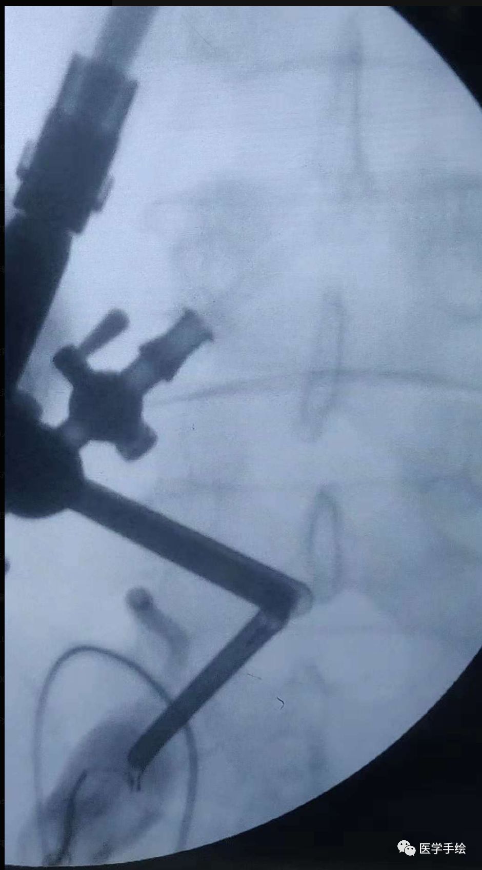 图文结合：单侧双通道内镜技术（UBE）原来没这么难！