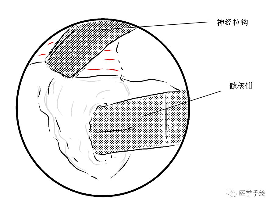 图文结合：单侧双通道内镜技术（UBE）原来没这么难！