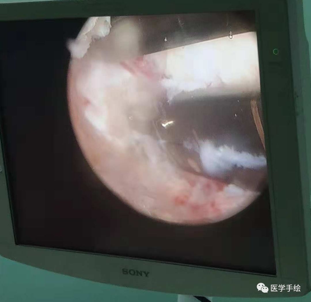 图文结合：单侧双通道内镜技术（UBE）原来没这么难！