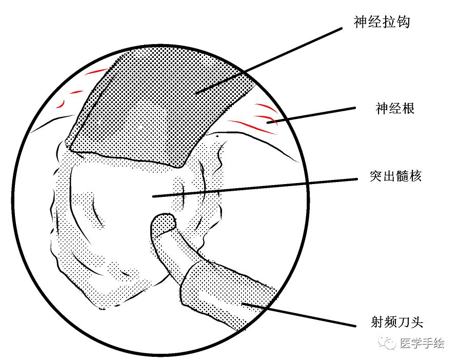图文结合：单侧双通道内镜技术（UBE）原来没这么难！