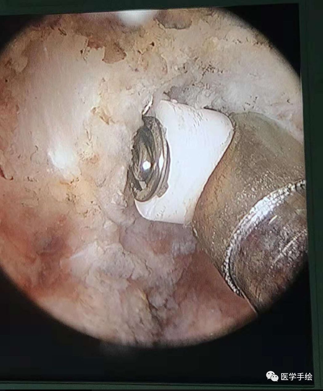 图文结合：单侧双通道内镜技术（UBE）原来没这么难！