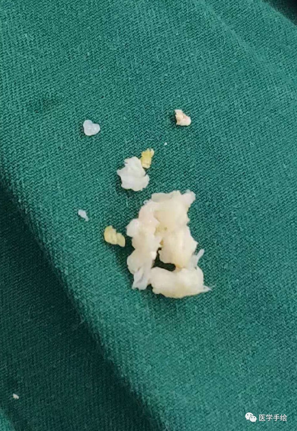 图文结合：单侧双通道内镜技术（UBE）原来没这么难！