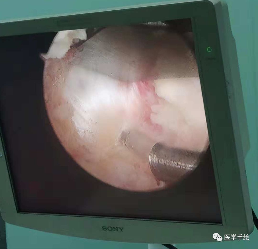 图文结合：单侧双通道内镜技术（UBE）原来没这么难！